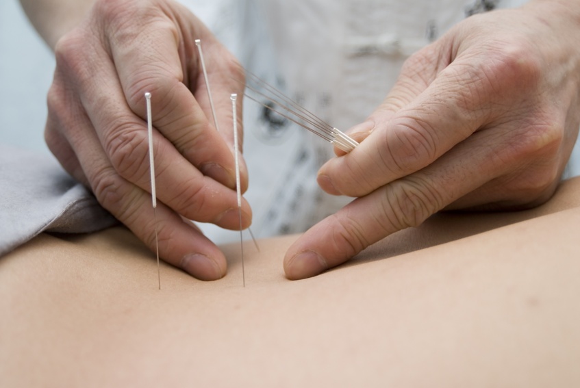 Doctor uses needles for treatment of the patient